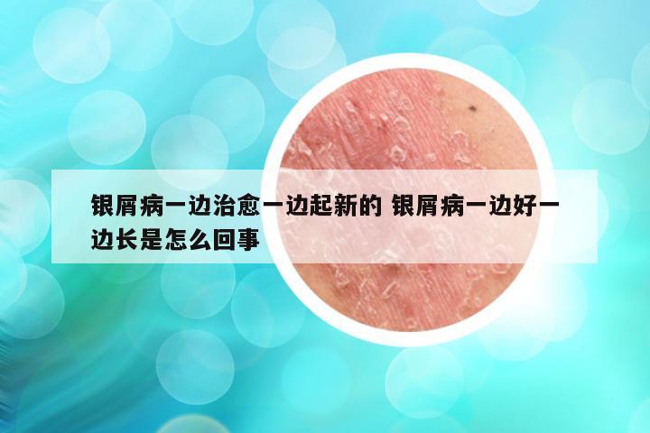 银屑病一边治愈一边起新的 银屑病一边好一边长是怎么回事