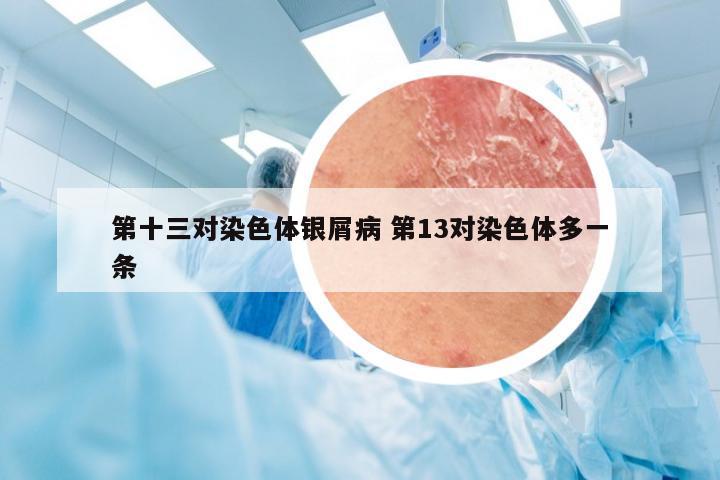 第十三对染色体银屑病 第13对染色体多一条