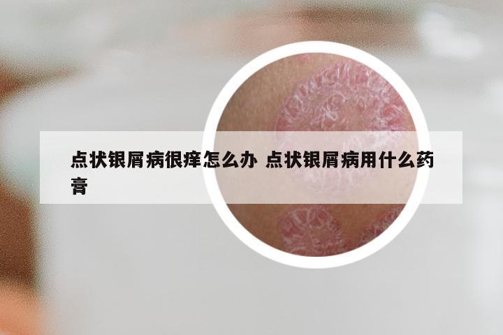 点状银屑病很痒怎么办 点状银屑病用什么药膏