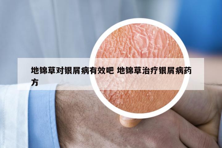 地锦草对银屑病有效吧 地锦草治疗银屑病药方