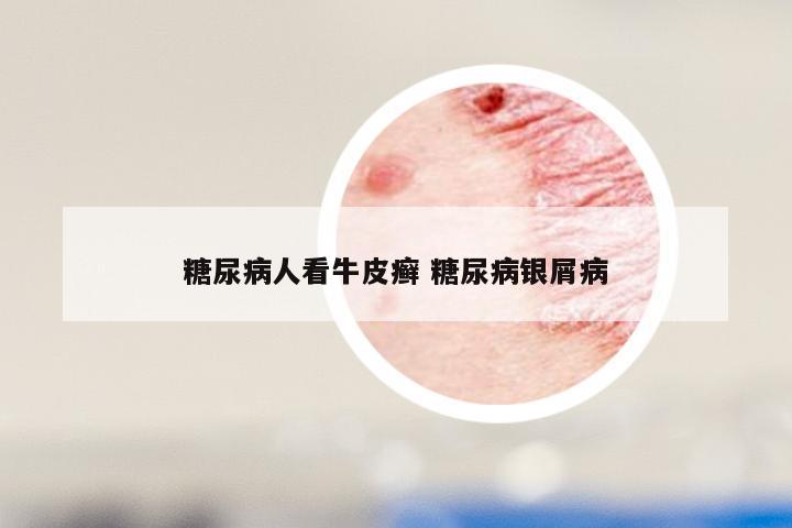 糖尿病人看牛皮癣 糖尿病银屑病