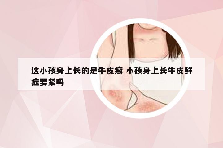 这小孩身上长的是牛皮癣 小孩身上长牛皮鲜症要紧吗