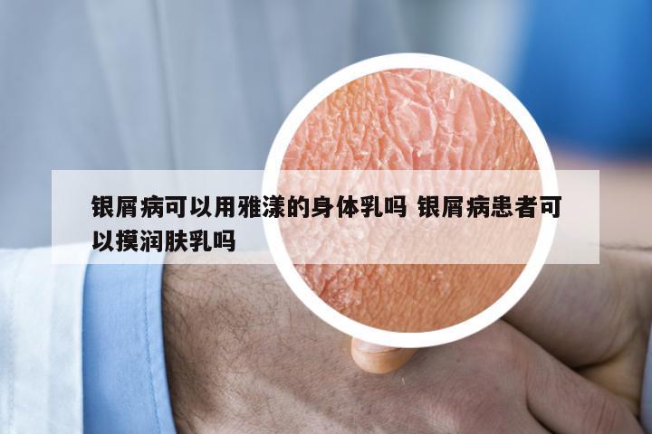 银屑病可以用雅漾的身体乳吗 银屑病患者可以摸润肤乳吗