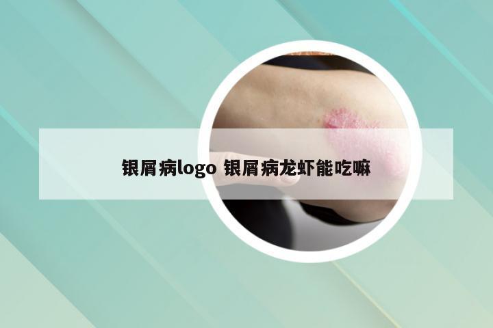 银屑病logo 银屑病龙虾能吃嘛