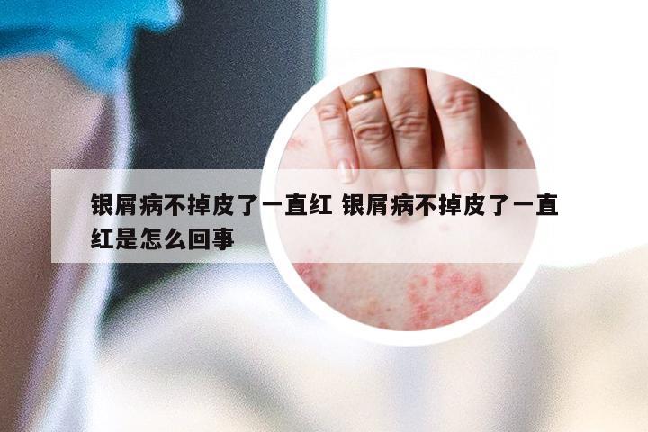 银屑病不掉皮了一直红 银屑病不掉皮了一直红是怎么回事