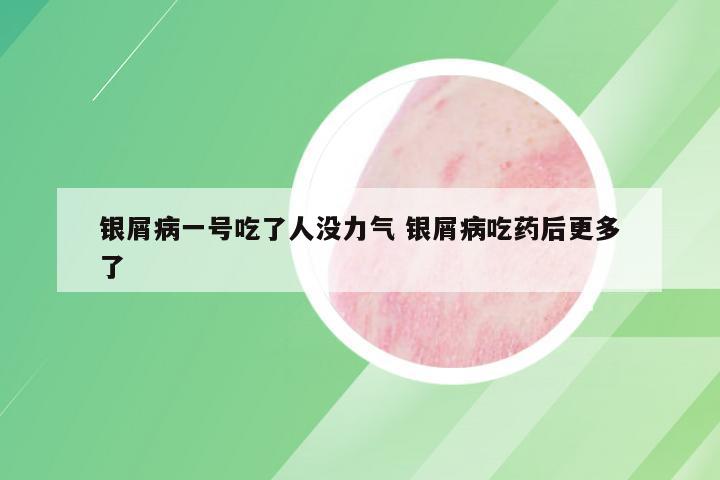 银屑病一号吃了人没力气 银屑病吃药后更多了