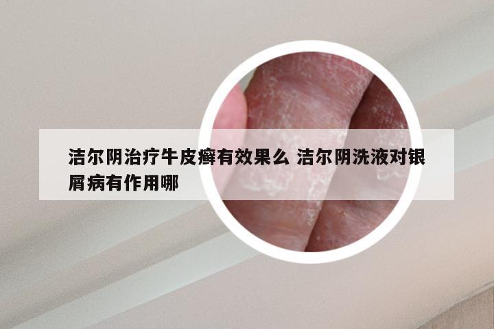 洁尔阴治疗牛皮癣有效果么 洁尔阴洗液对银屑病有作用哪