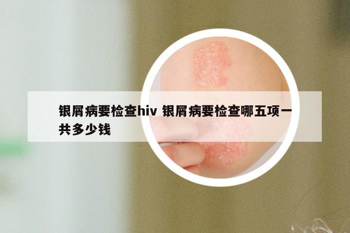银屑病要检查hiv 银屑病要检查哪五项一共多少钱
