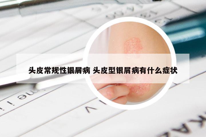 头皮常规性银屑病 头皮型银屑病有什么症状