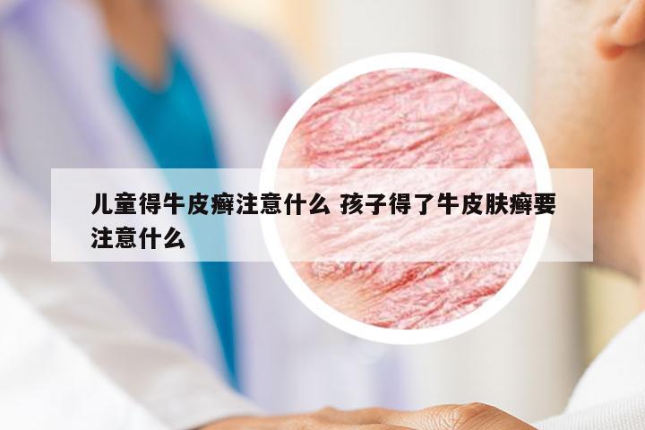 儿童得牛皮癣注意什么 孩子得了牛皮肤癣要注意什么
