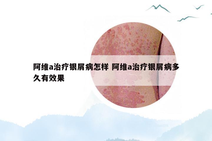 阿维a治疗银屑病怎样 阿维a治疗银屑病多久有效果
