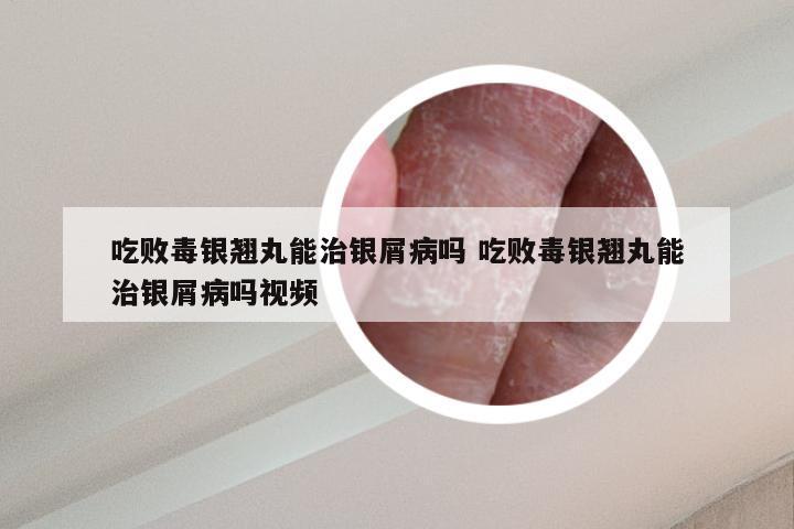吃败毒银翘丸能治银屑病吗 吃败毒银翘丸能治银屑病吗视频