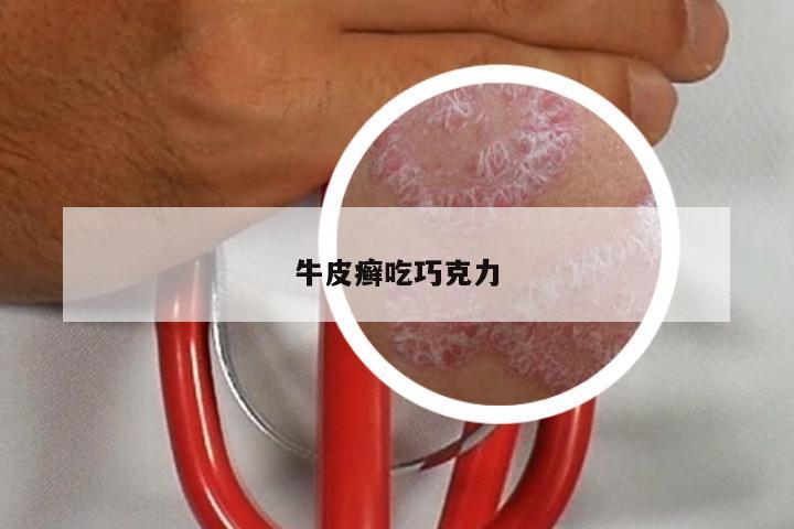 牛皮癣吃巧克力
