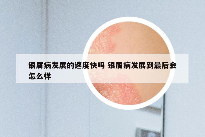 银屑病发展的速度快吗 银屑病发展到最后会怎么样