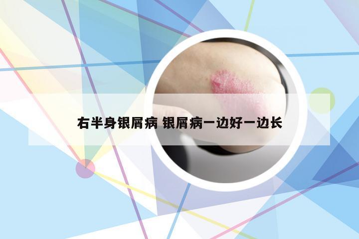 右半身银屑病 银屑病一边好一边长