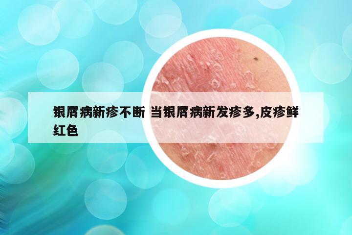 银屑病新疹不断 当银屑病新发疹多,皮疹鲜红色