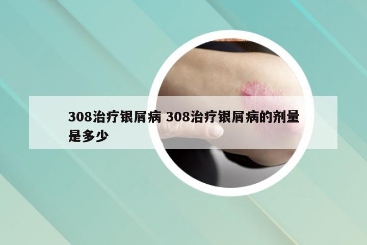 308治疗银屑病 308治疗银屑病的剂量是多少