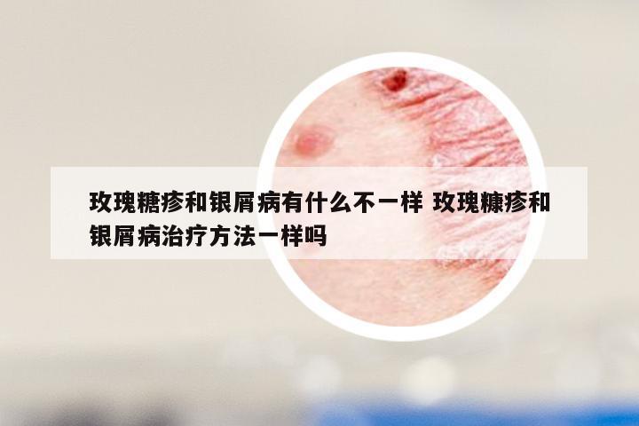 玫瑰糖疹和银屑病有什么不一样 玫瑰糠疹和银屑病治疗方法一样吗