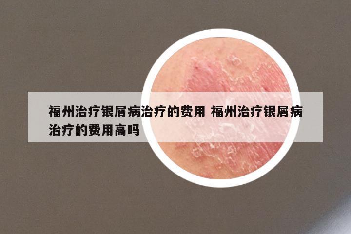 福州治疗银屑病治疗的费用 福州治疗银屑病治疗的费用高吗