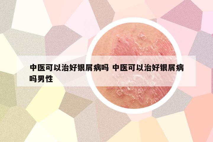 中医可以治好银屑病吗 中医可以治好银屑病吗男性