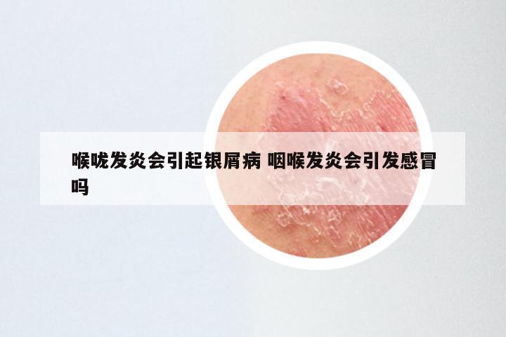 喉咙发炎会引起银屑病 咽喉发炎会引发感冒吗