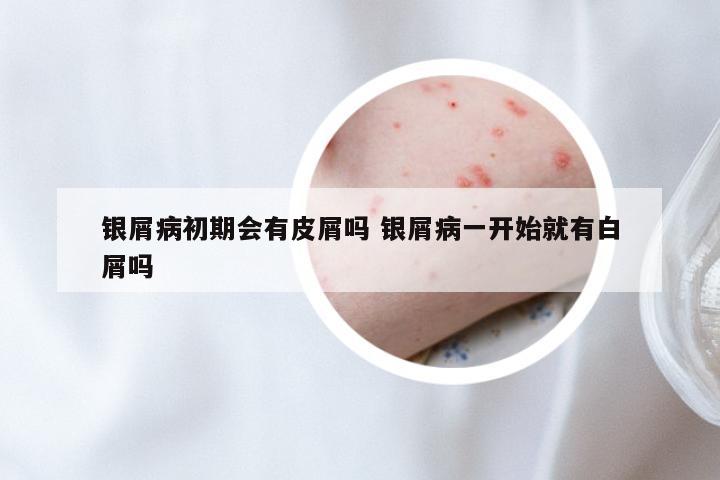 银屑病初期会有皮屑吗 银屑病一开始就有白屑吗