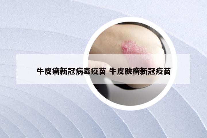 牛皮癣新冠病毒疫苗 牛皮肤癣新冠疫苗