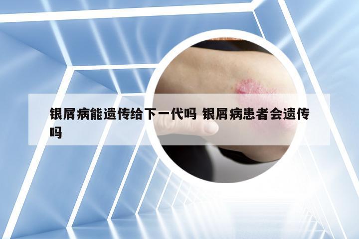 银屑病能遗传给下一代吗 银屑病患者会遗传吗