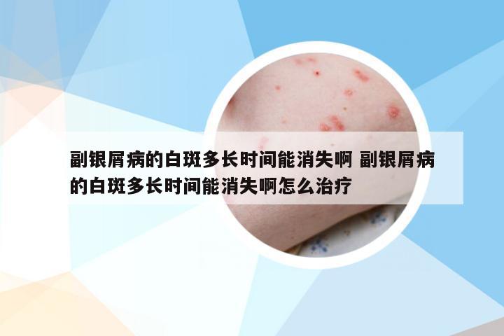 副银屑病的白斑多长时间能消失啊 副银屑病的白斑多长时间能消失啊怎么治疗