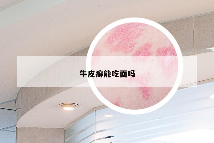 牛皮癣能吃面吗