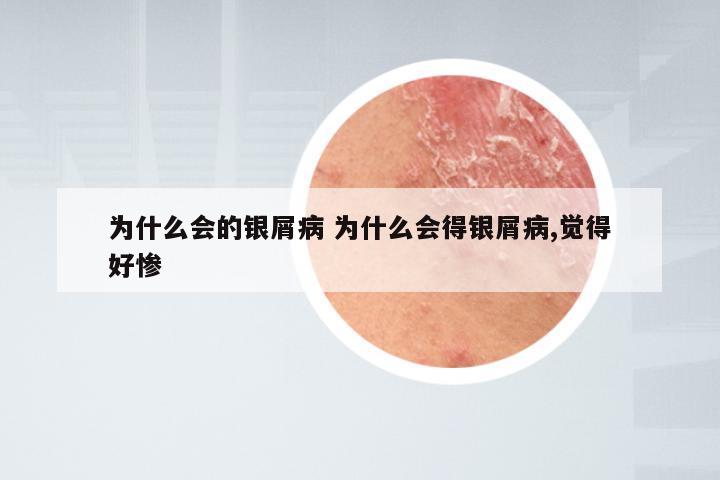 为什么会的银屑病 为什么会得银屑病,觉得好惨