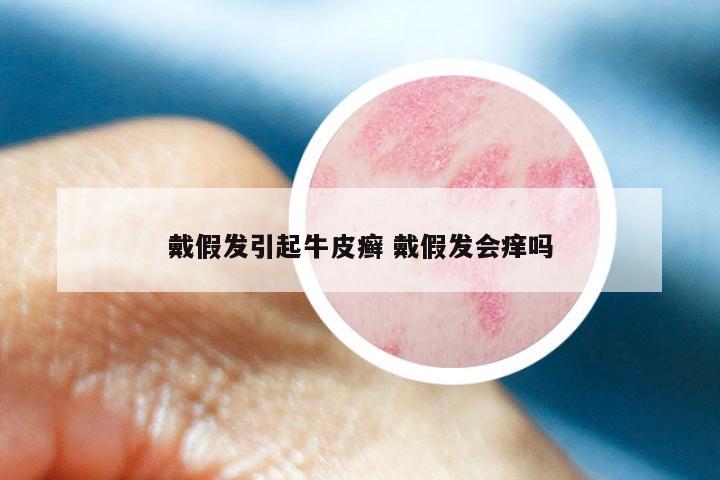 戴假发引起牛皮癣 戴假发会痒吗