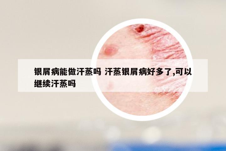 银屑病能做汗蒸吗 汗蒸银屑病好多了,可以继续汗蒸吗