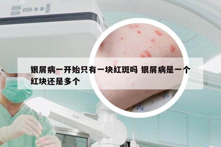 银屑病一开始只有一块红斑吗 银屑病是一个红块还是多个