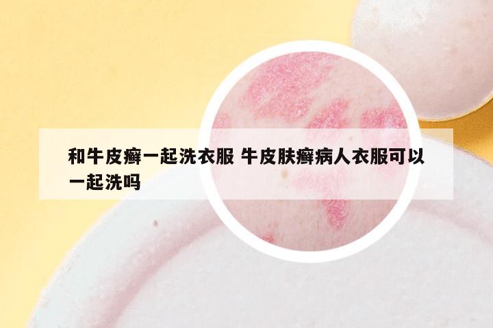 和牛皮癣一起洗衣服 牛皮肤癣病人衣服可以一起洗吗