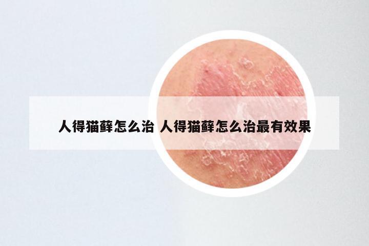 人得猫藓怎么治 人得猫藓怎么治最有效果