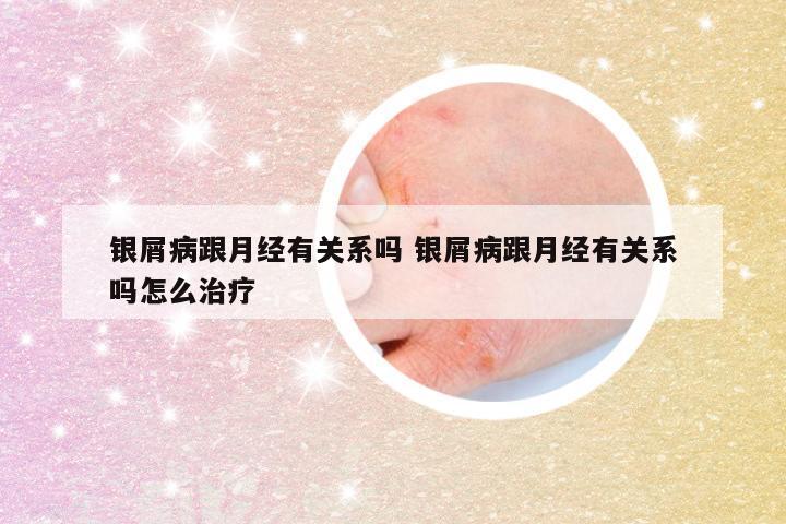 银屑病跟月经有关系吗 银屑病跟月经有关系吗怎么治疗