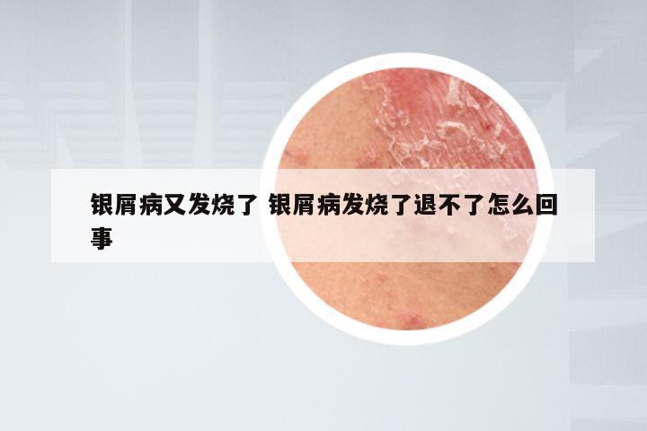 银屑病又发烧了 银屑病发烧了退不了怎么回事