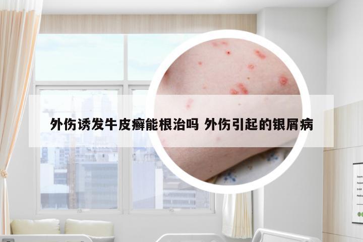 外伤诱发牛皮癣能根治吗 外伤引起的银屑病