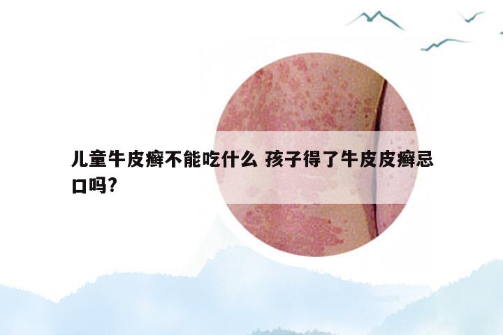 儿童牛皮癣不能吃什么 孩子得了牛皮皮癣忌口吗?
