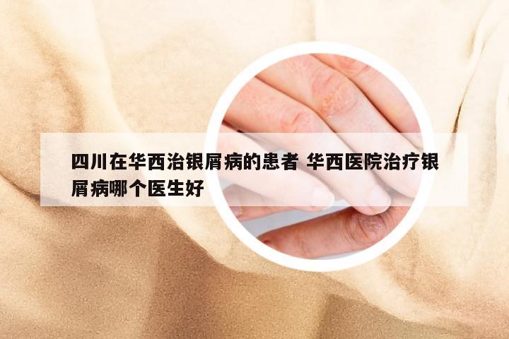 四川在华西治银屑病的患者 华西医院治疗银屑病哪个医生好