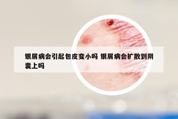 银屑病会引起包皮变小吗 银屑病会扩散到阴囊上吗