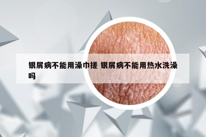 银屑病不能用澡巾搓 银屑病不能用热水洗澡吗