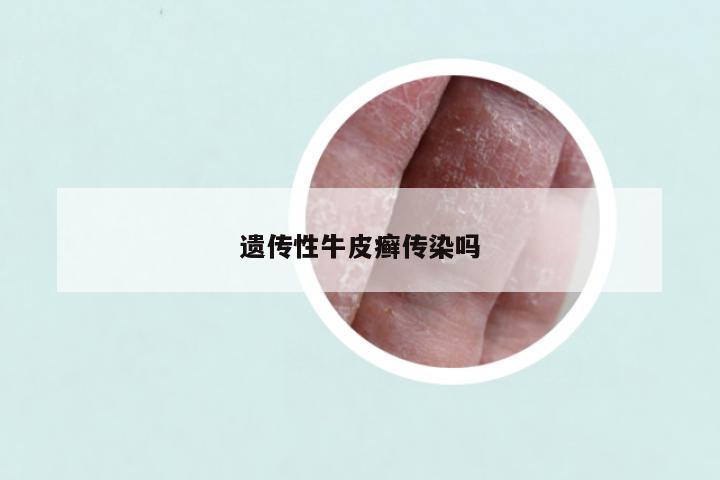 遗传性牛皮癣传染吗
