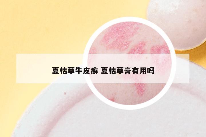 夏枯草牛皮癣 夏枯草膏有用吗