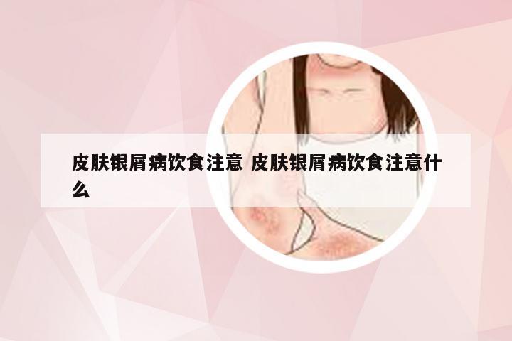 皮肤银屑病饮食注意 皮肤银屑病饮食注意什么