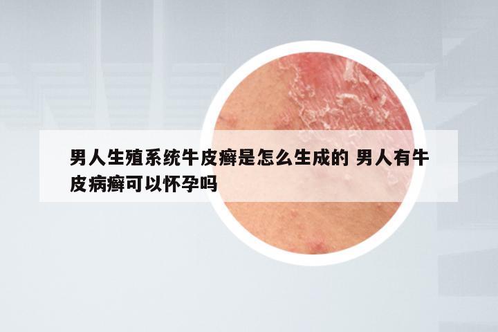 男人生殖系统牛皮癣是怎么生成的 男人有牛皮病癣可以怀孕吗