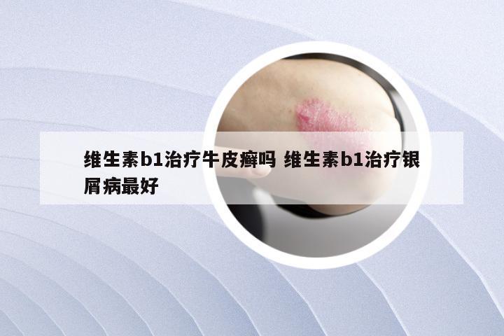 维生素b1治疗牛皮癣吗 维生素b1治疗银屑病最好