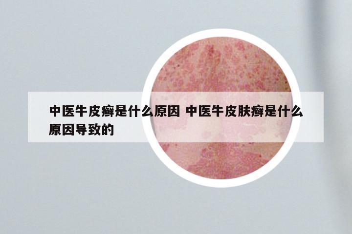中医牛皮癣是什么原因 中医牛皮肤癣是什么原因导致的