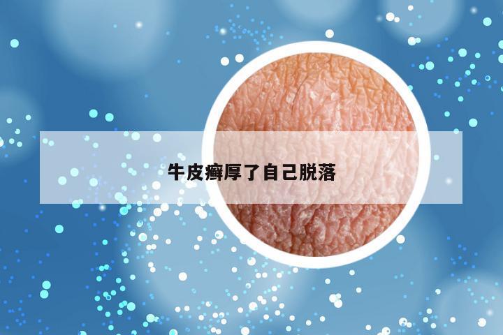 牛皮癣厚了自己脱落